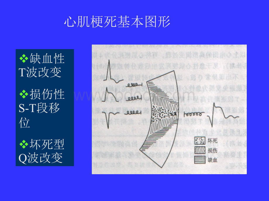 第四节心肌梗死与心肌缺血.ppt_第3页