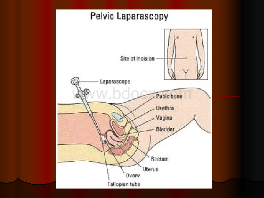 妇科腹腔镜手术的并发症.ppt_第2页