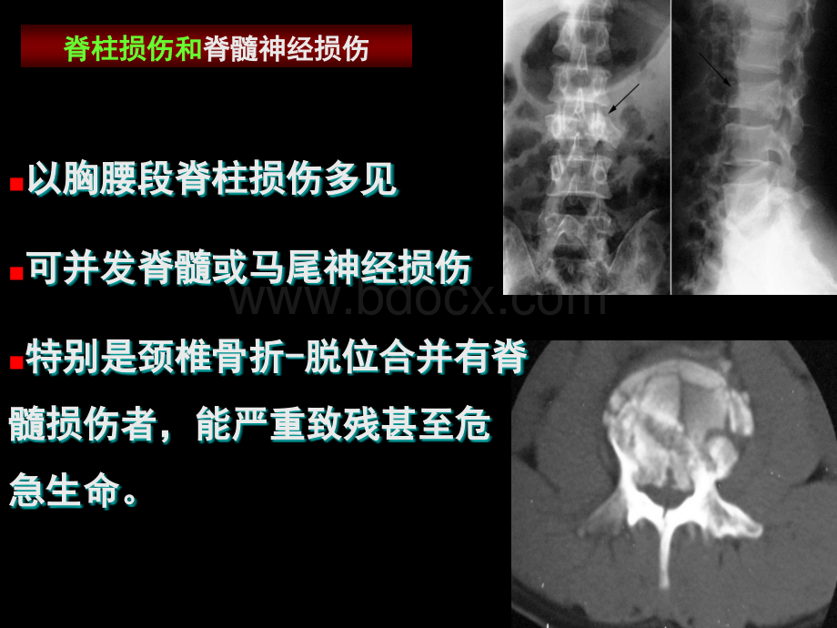 四肢脊柱骨折的紧急处理.ppt_第3页