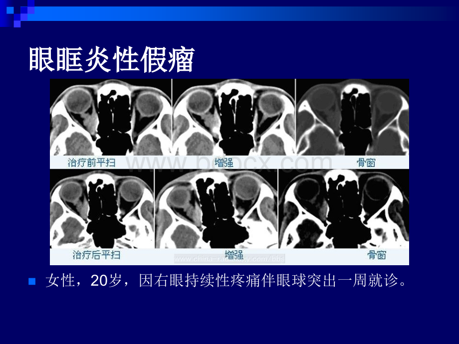 五官和颈部典型病例读片PPT格式课件下载.ppt_第2页