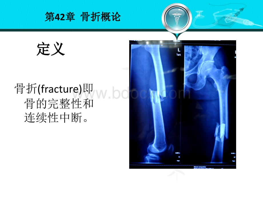 58骨折概论PPT文档格式.ppt_第3页