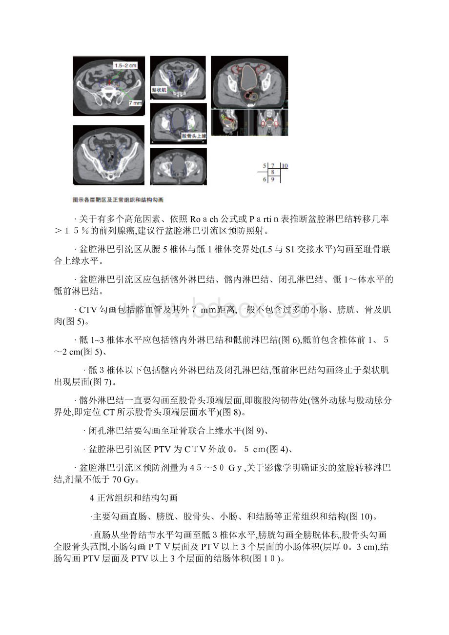 常见肿瘤靶区勾画.docx_第3页