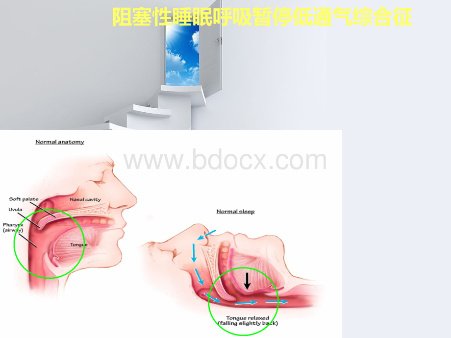 阻塞性睡眠呼吸暂停OSAHS_精品文档PPT推荐.ppt