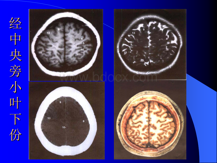 颅脑断层面CT解剖_精品文档.ppt_第2页