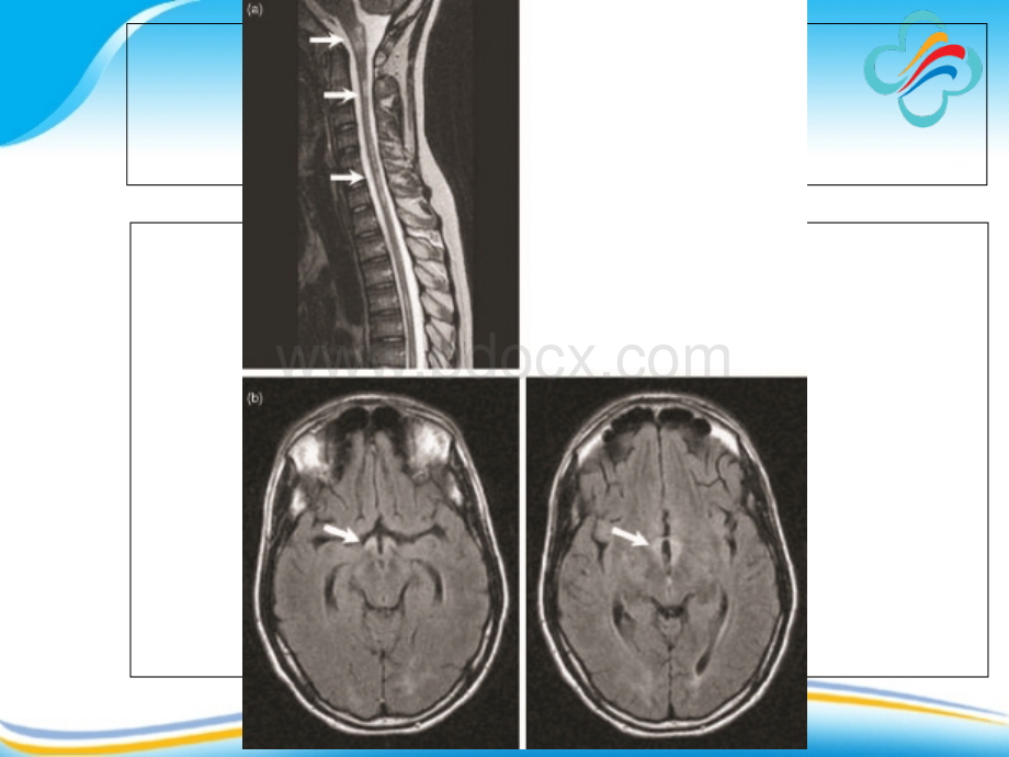 视神经脊髓炎与多发性硬化-_精品文档PPT文件格式下载.ppt_第2页
