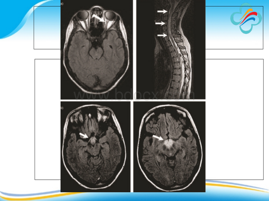 视神经脊髓炎与多发性硬化-_精品文档.ppt_第3页