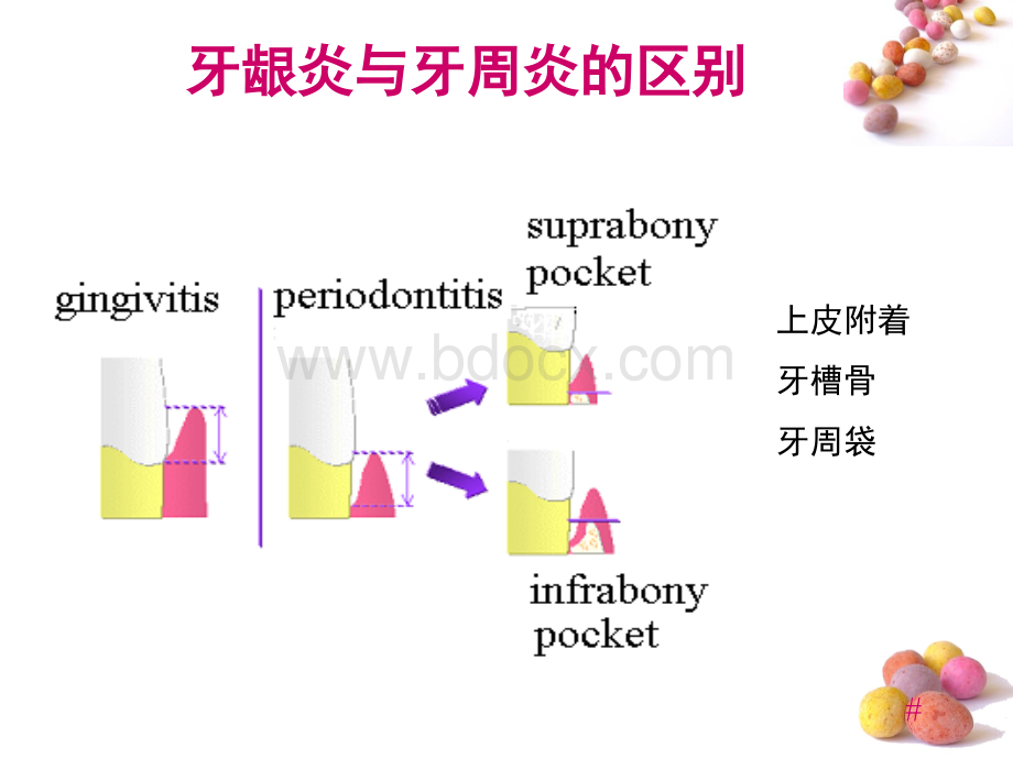 龈下刮治术_精品文档.ppt_第3页