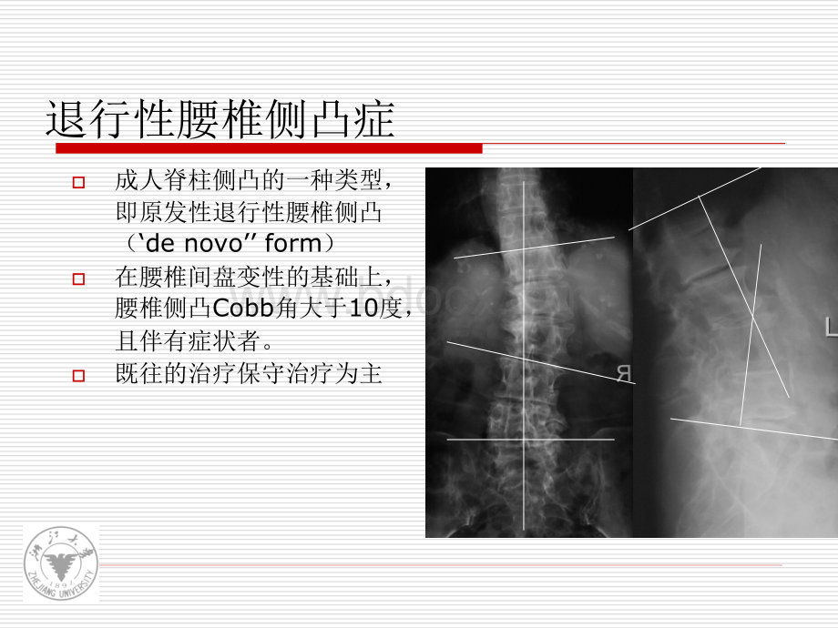 退行性腰椎侧凸的分型和手术策略_精品文档PPT资料.ppt_第2页