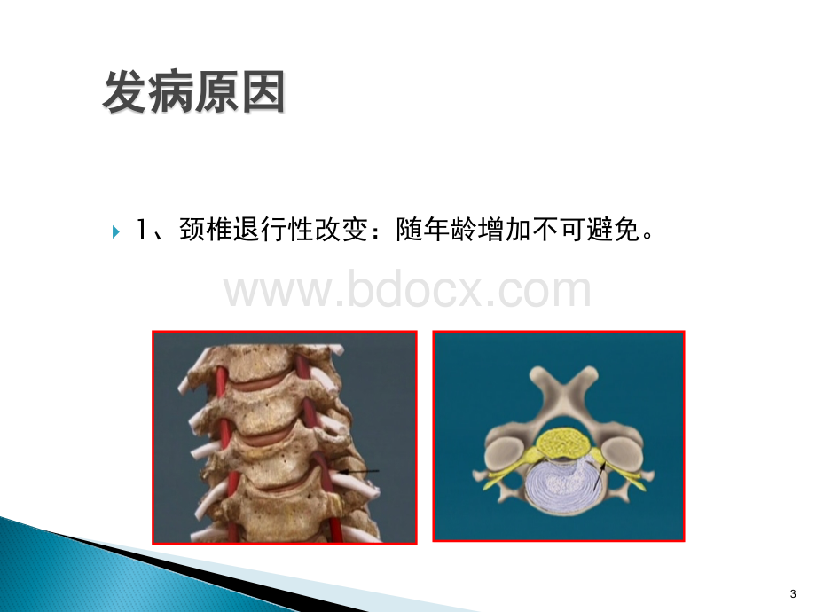 颈椎病的预防及保健_精品文档PPT文档格式.ppt_第3页