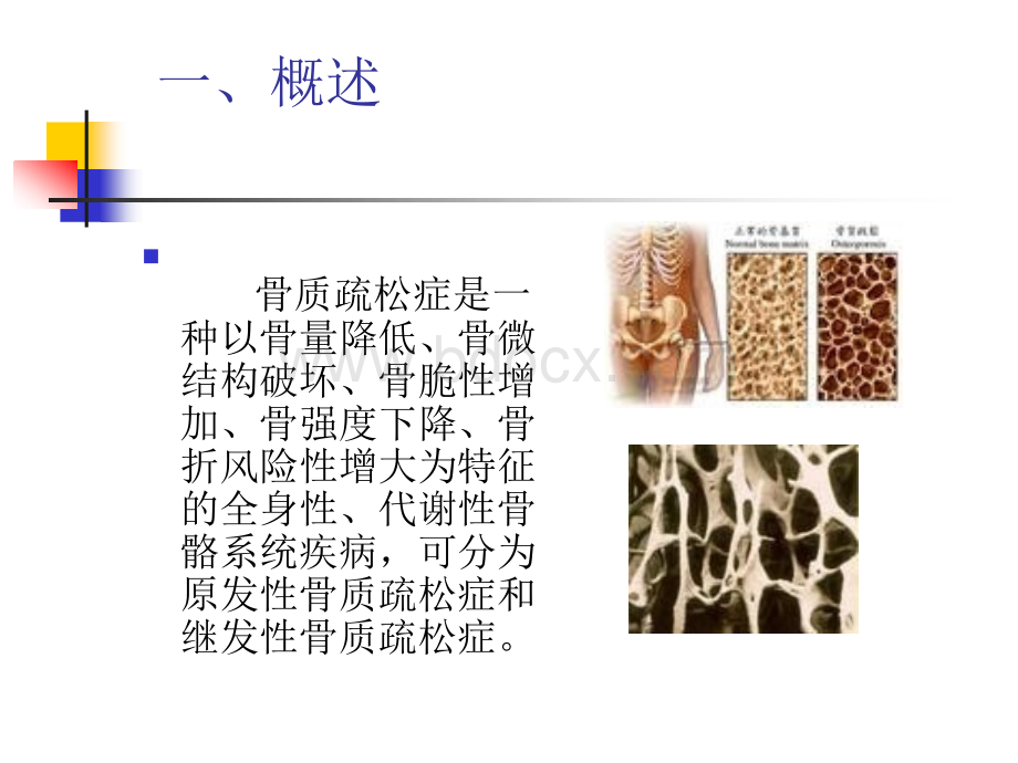 骨质疏松症诊断治疗进展陈智琨_精品文档PPT推荐.ppt_第2页