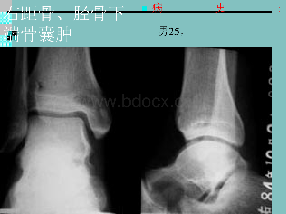 骨骼病变图像_精品文档.ppt_第2页