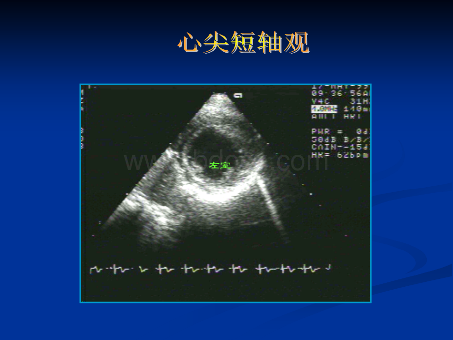 超声心动图概述ppt3_精品文档.ppt_第2页