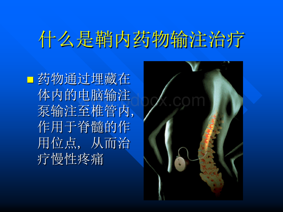 鞘内药物输注治疗慢性疼痛_精品文档.ppt_第2页