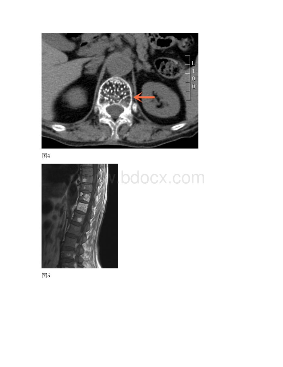 胸腰椎多发结节状异常信号多发骨髓瘤文档格式.docx_第3页