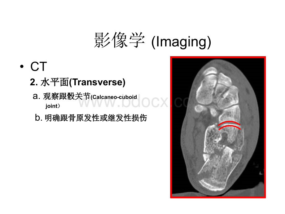 跟骨骨折影像学_精品文档PPT资料.ppt_第1页