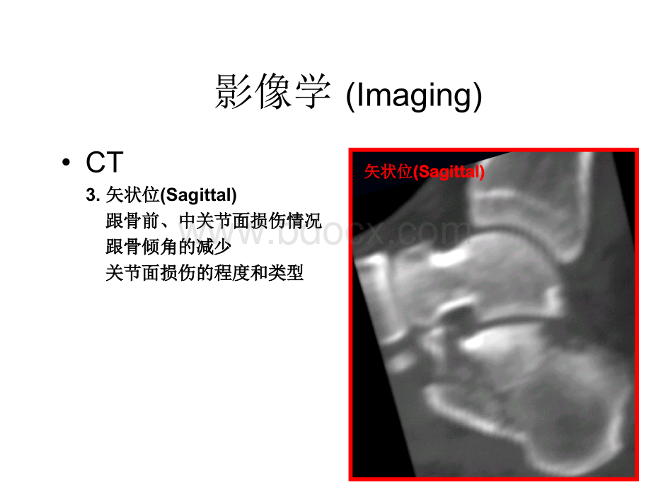 跟骨骨折影像学_精品文档PPT资料.ppt_第2页