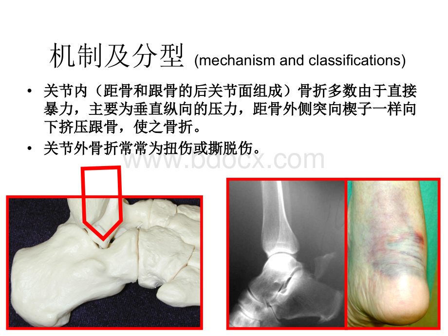 跟骨骨折影像学_精品文档PPT资料.ppt_第3页