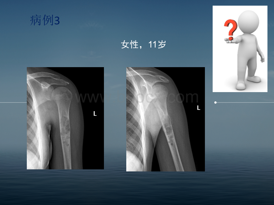 非骨化性纤维瘤的X线诊断及鉴别诊断_精品文档PPT文档格式.pptx_第3页