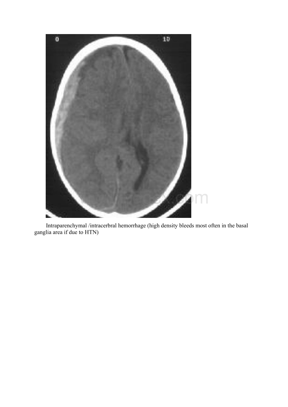 头颅损伤CT片阅读技巧Word下载.docx_第3页