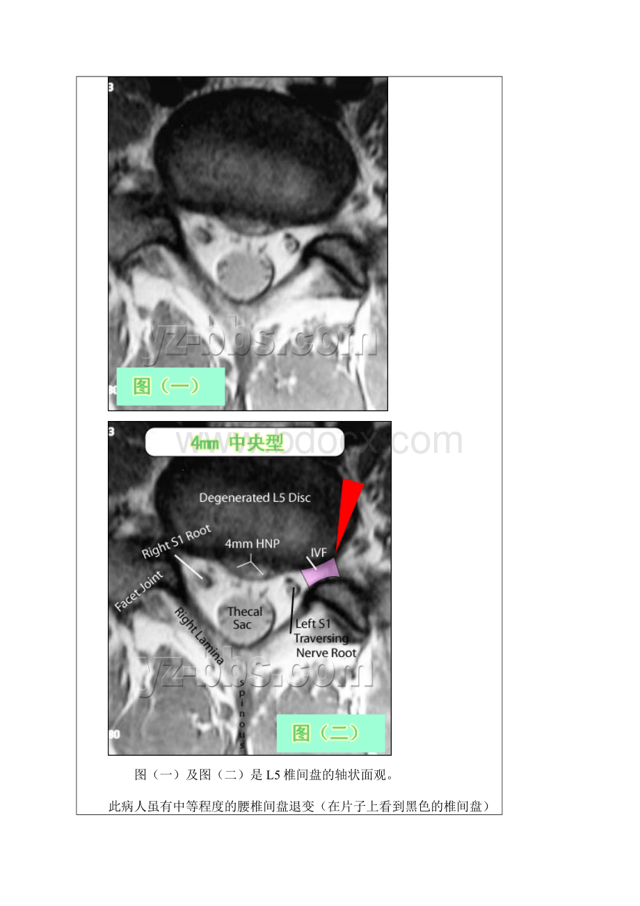 腰椎间盘突出CT和MRI磁共振片子的超好教程Word文档格式.docx_第3页