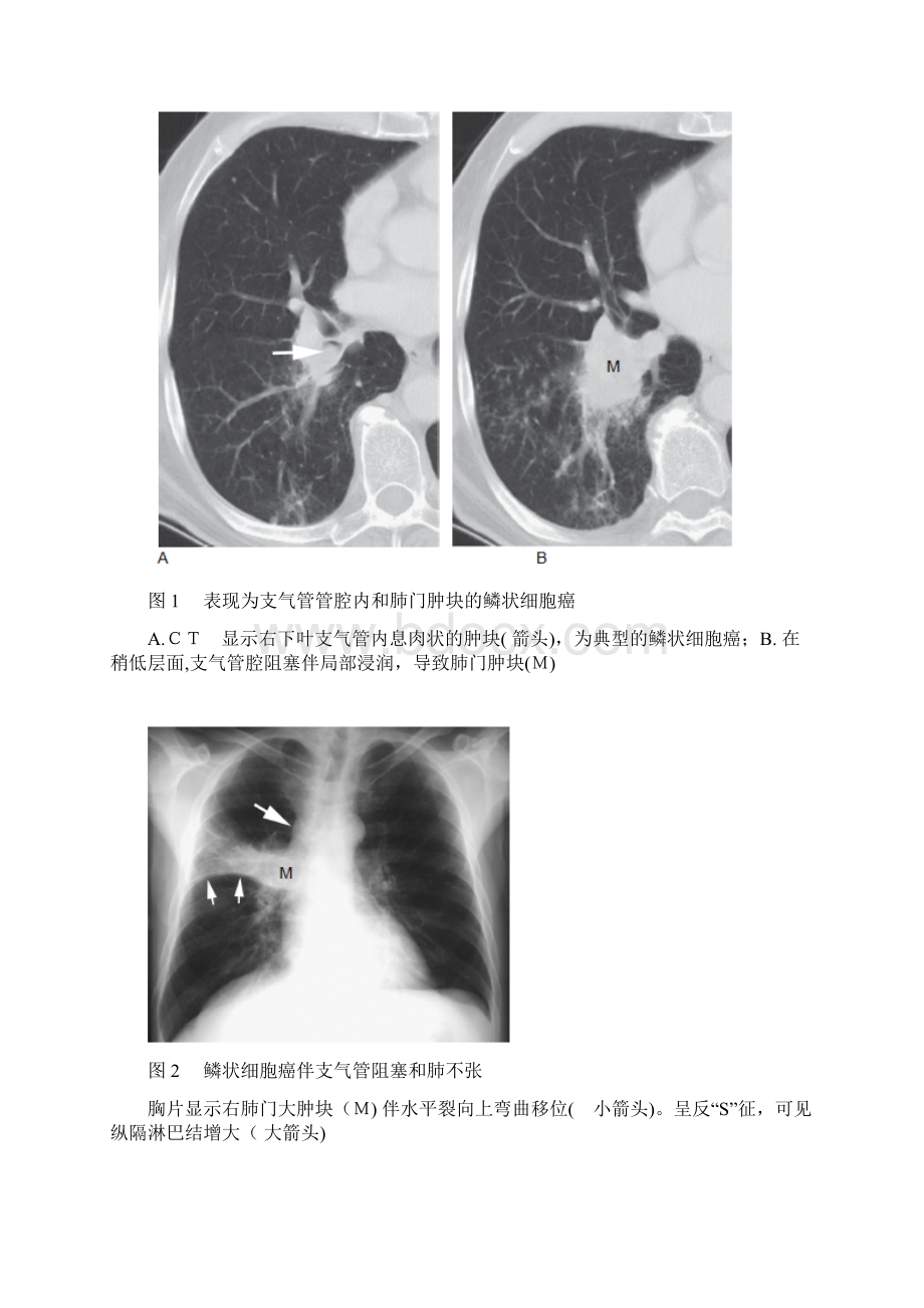 类肺癌的影像学表现.docx_第2页