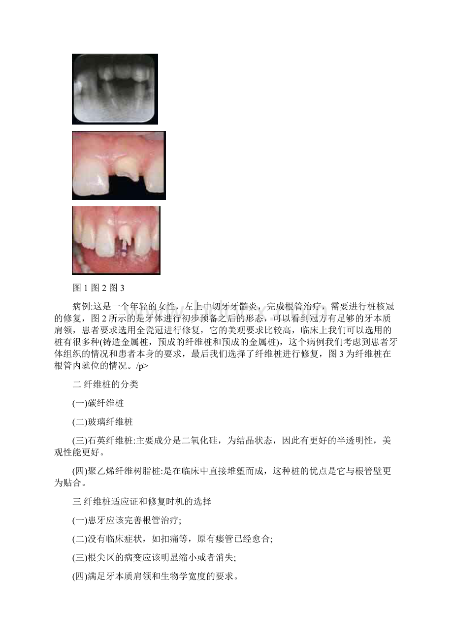 大面积牙体缺损修复新进展五纤维桩的临床应用.docx_第2页