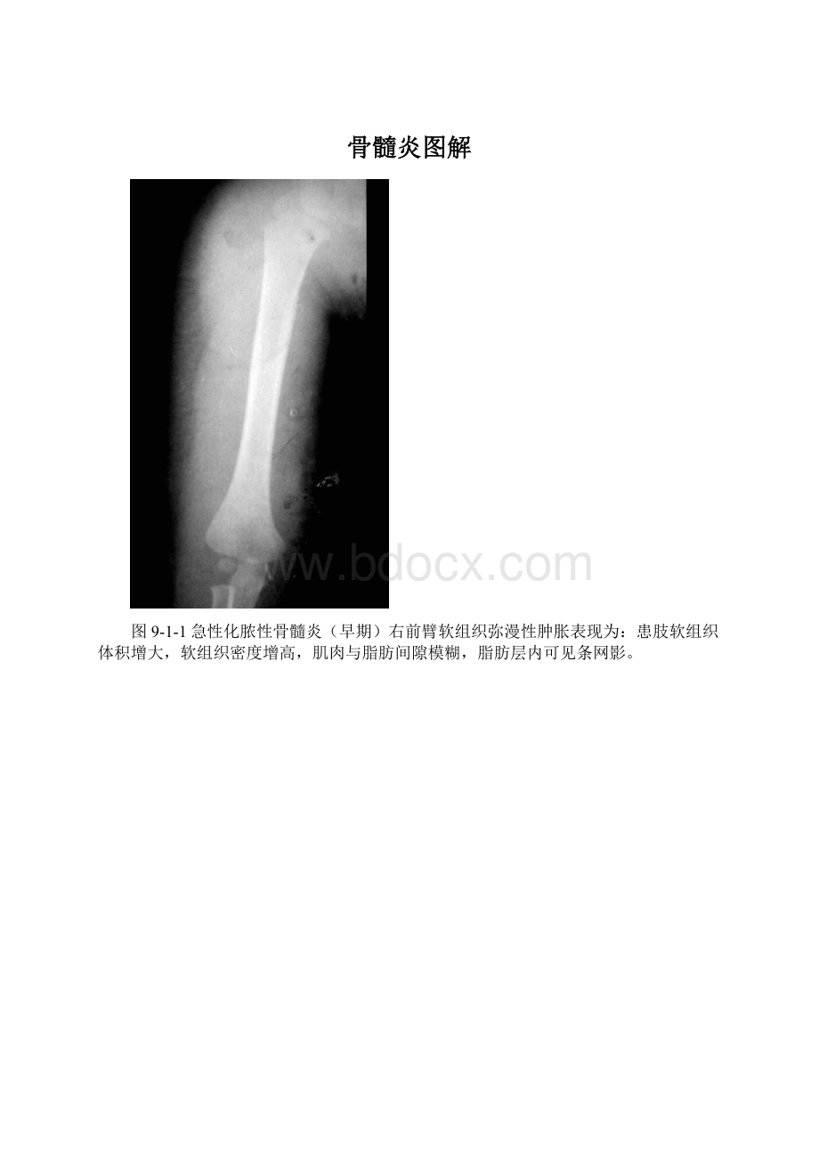 骨髓炎图解Word文档格式.docx