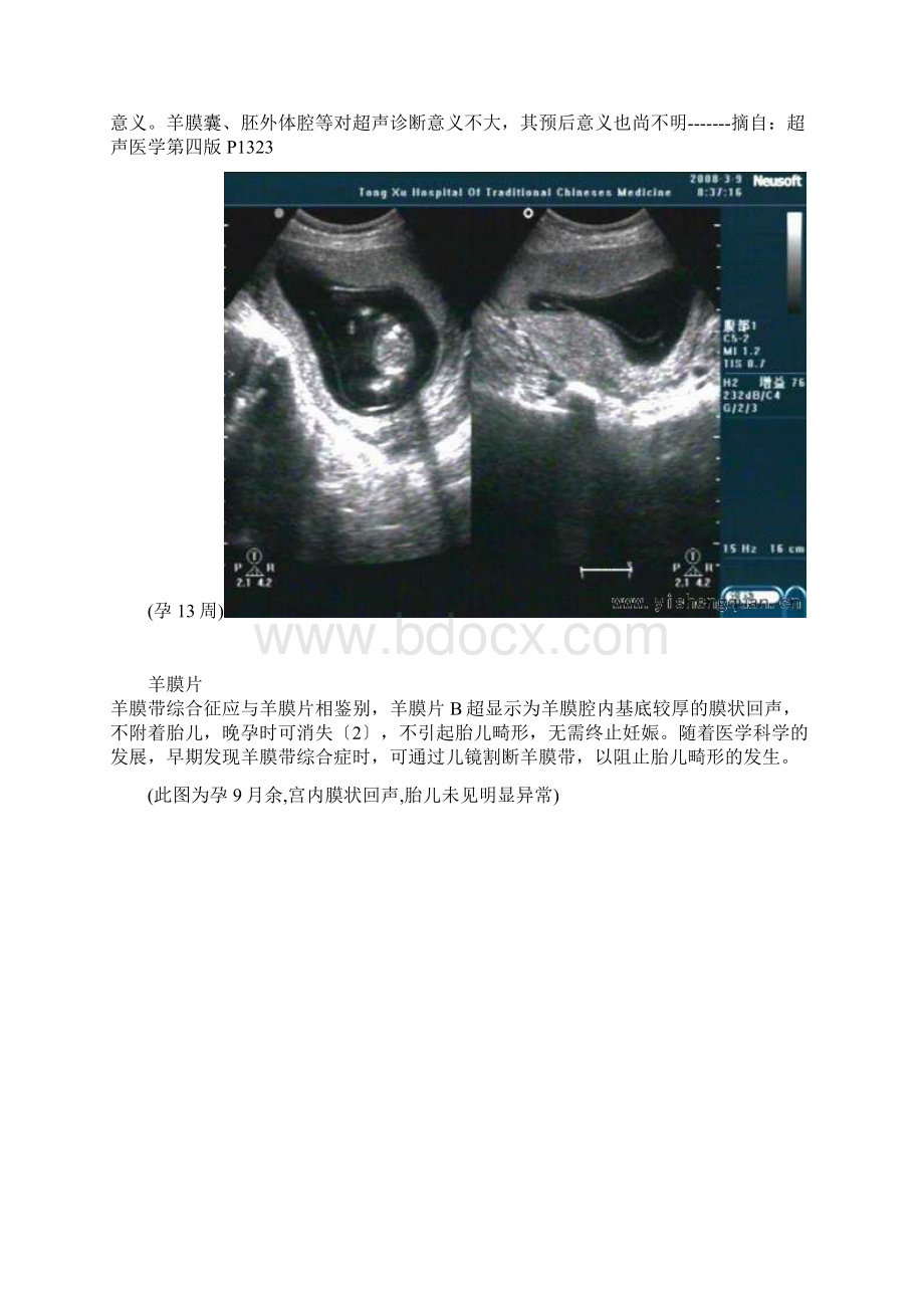 超声羊膜带羊膜片Word格式.docx_第2页