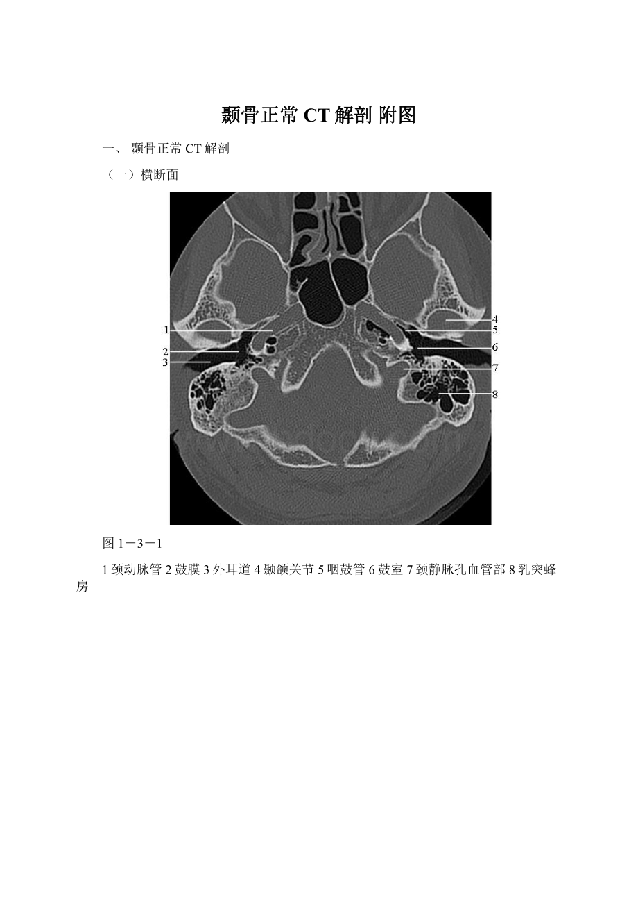 颞骨正常CT解剖 附图.docx