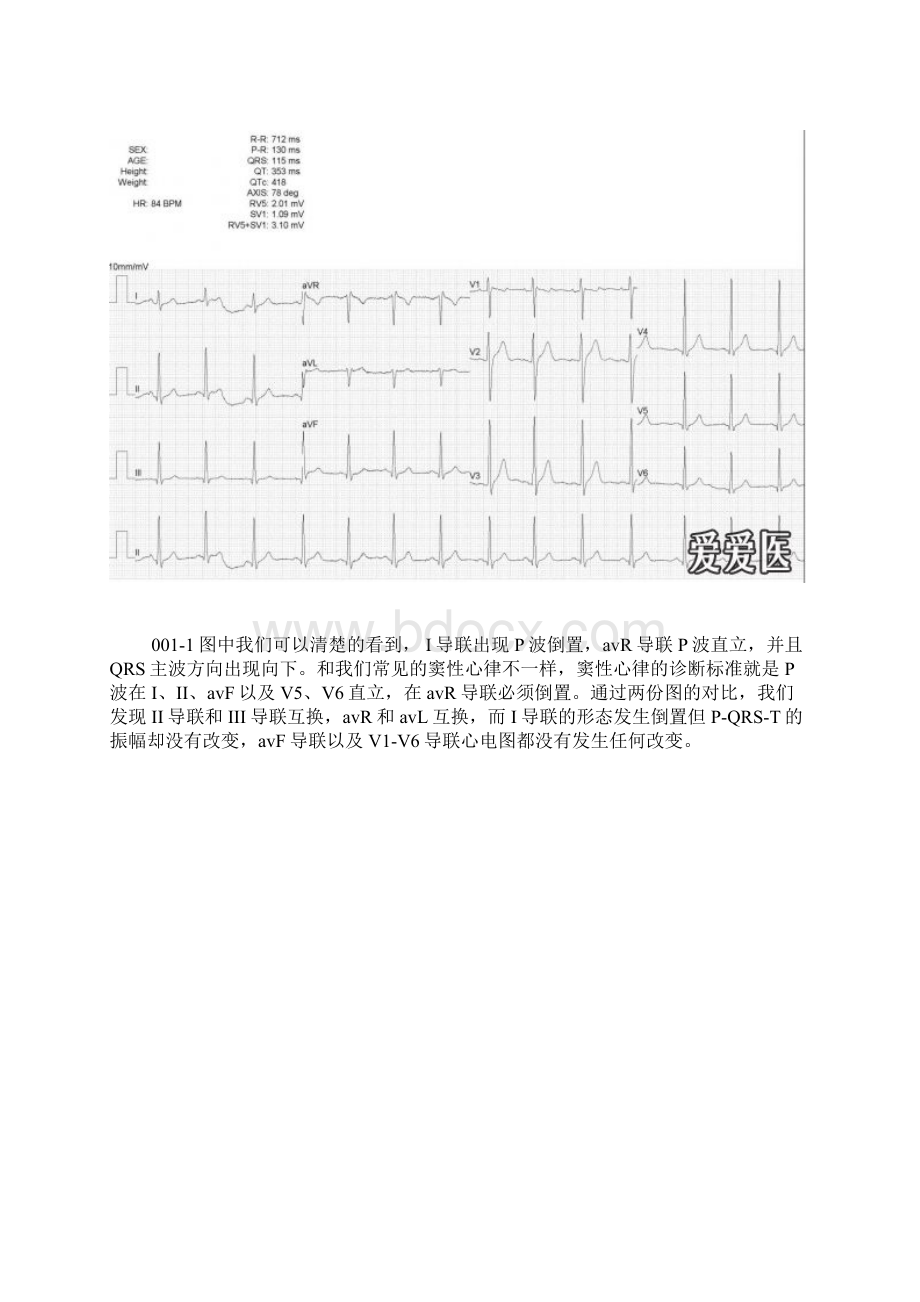 左右手反接和镜像性右位心.docx_第2页