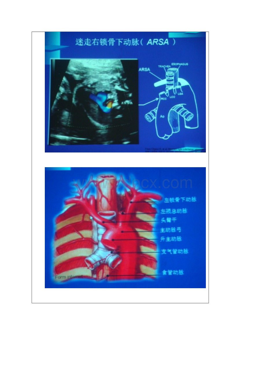 迷走右锁骨下动脉.docx_第3页