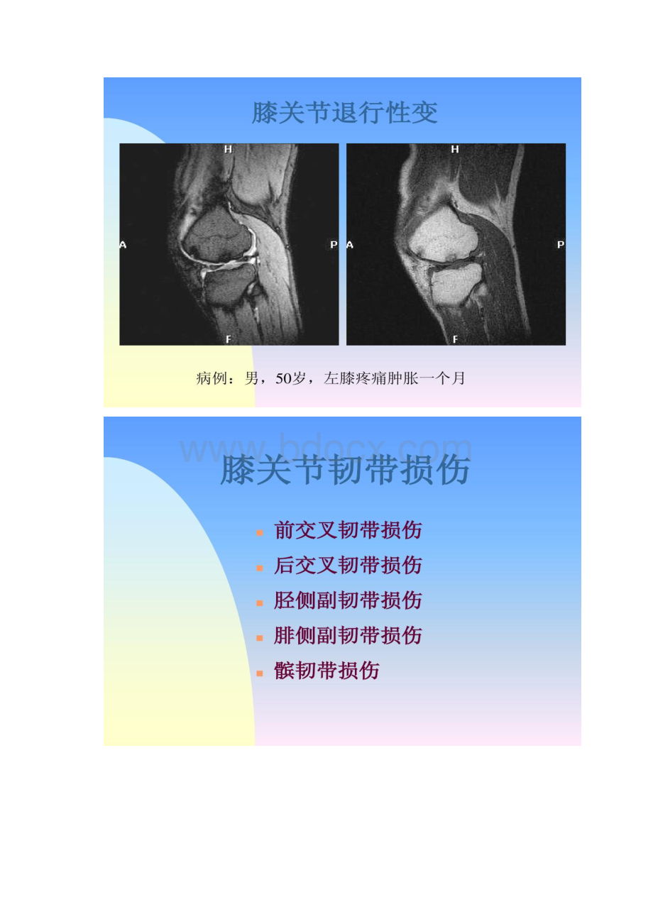 图文膝关节常见病MRI诊断精Word文档下载推荐.docx_第3页