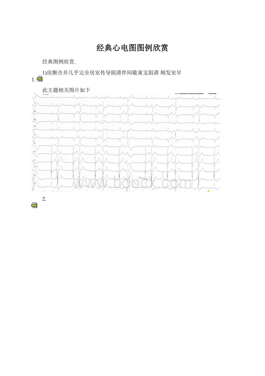 经典心电图图例欣赏Word文件下载.docx