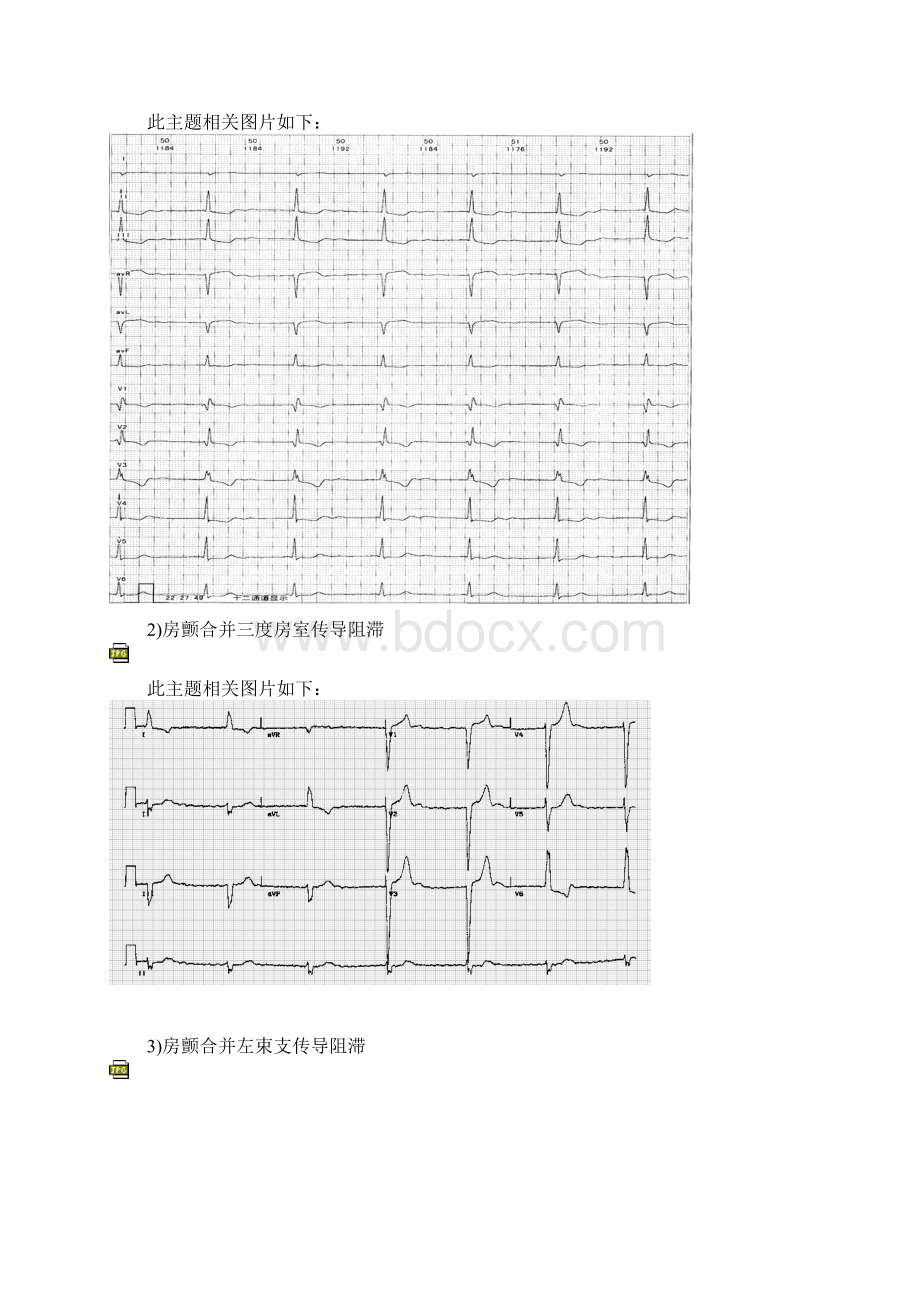 经典心电图图例欣赏.docx_第3页