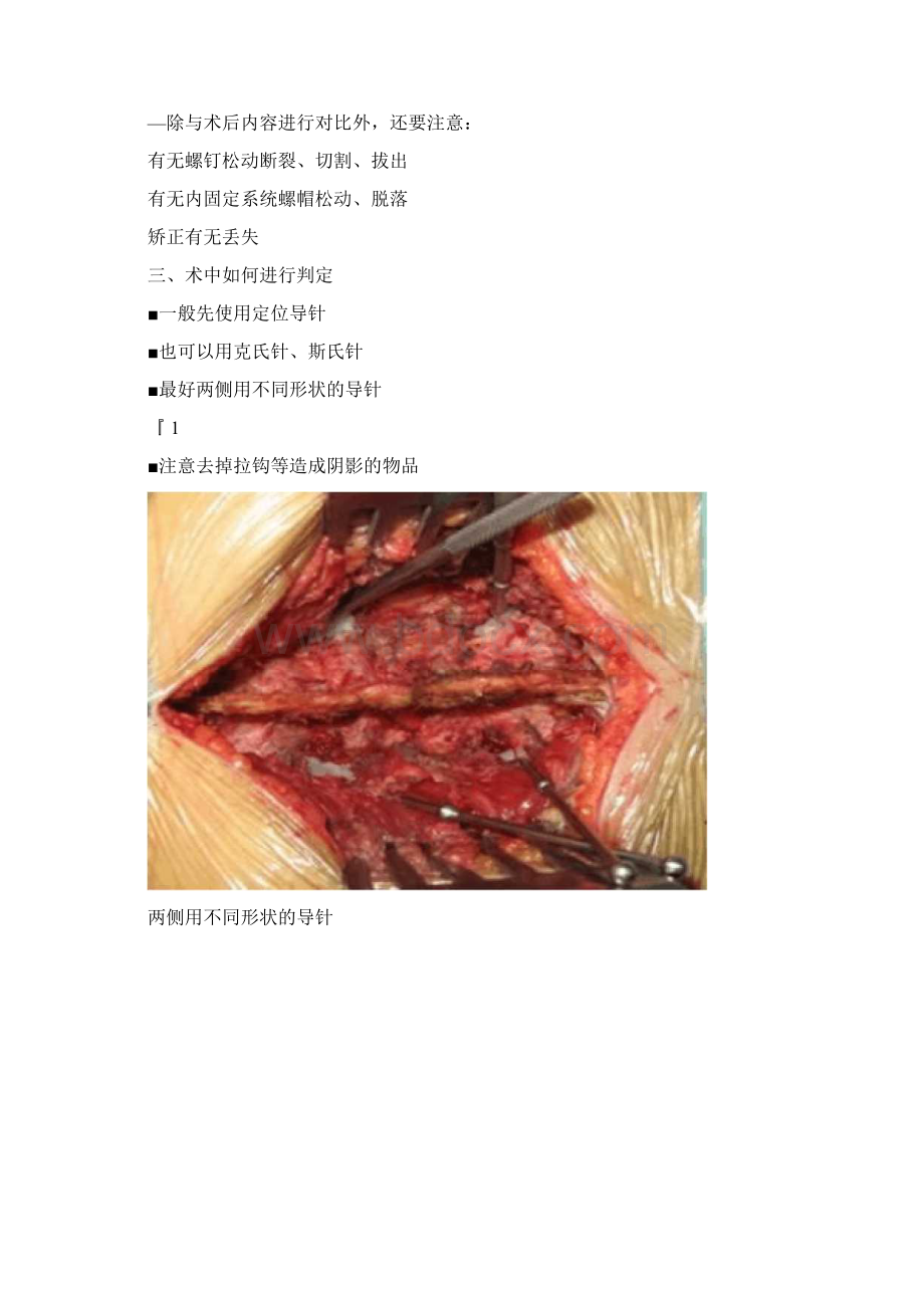 腰椎椎弓根螺钉位置及深度的判断.docx_第2页