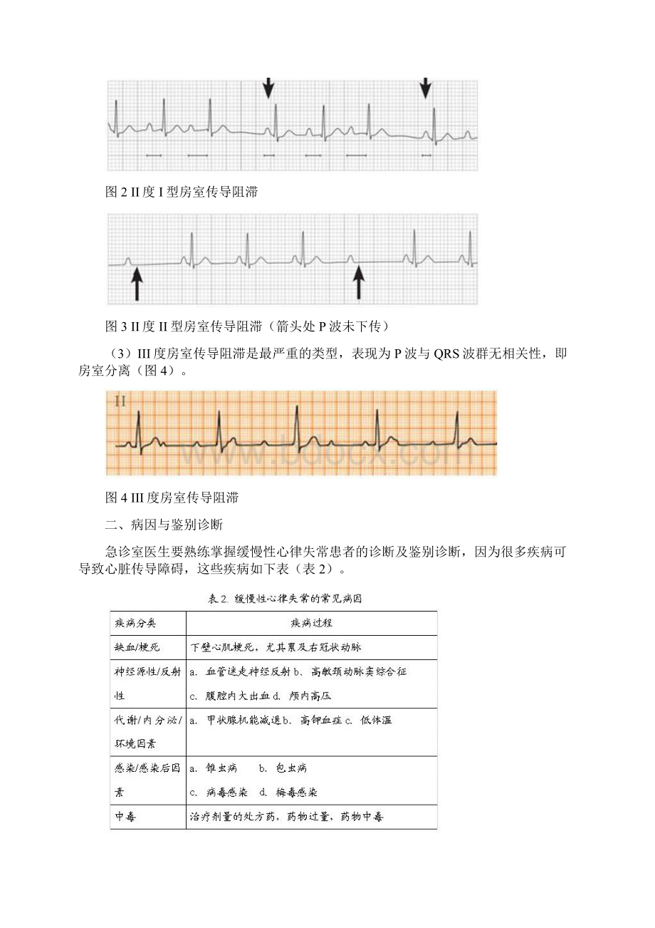 急诊缓慢性心律失常的诊断与处理.docx_第3页