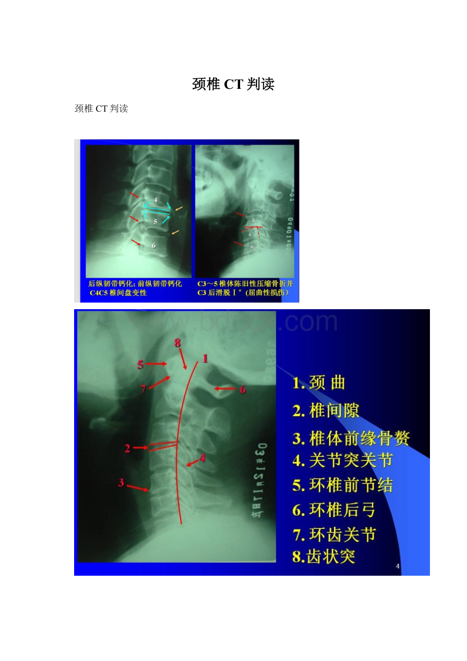 颈椎CT判读.docx