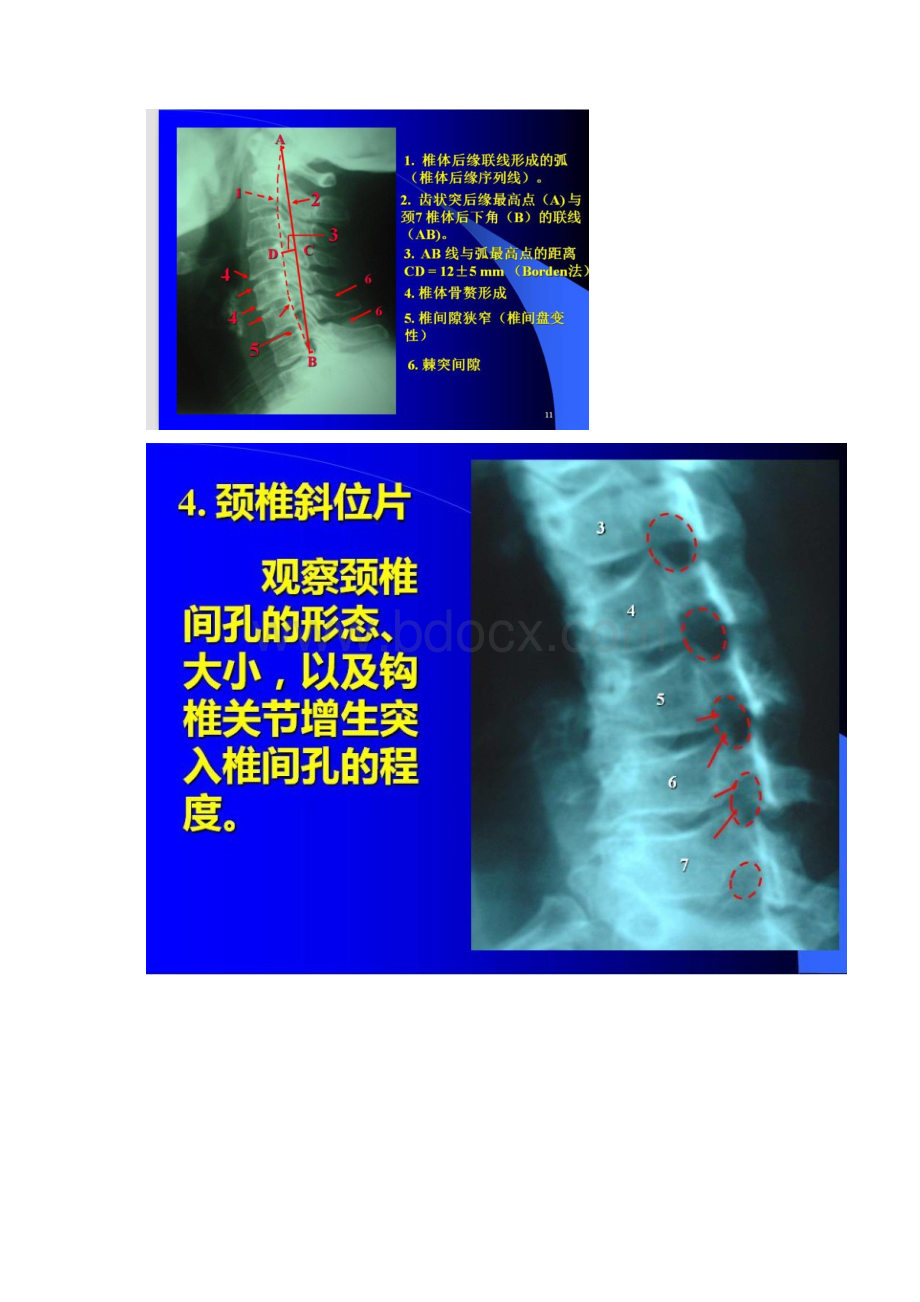 颈椎CT判读.docx_第2页