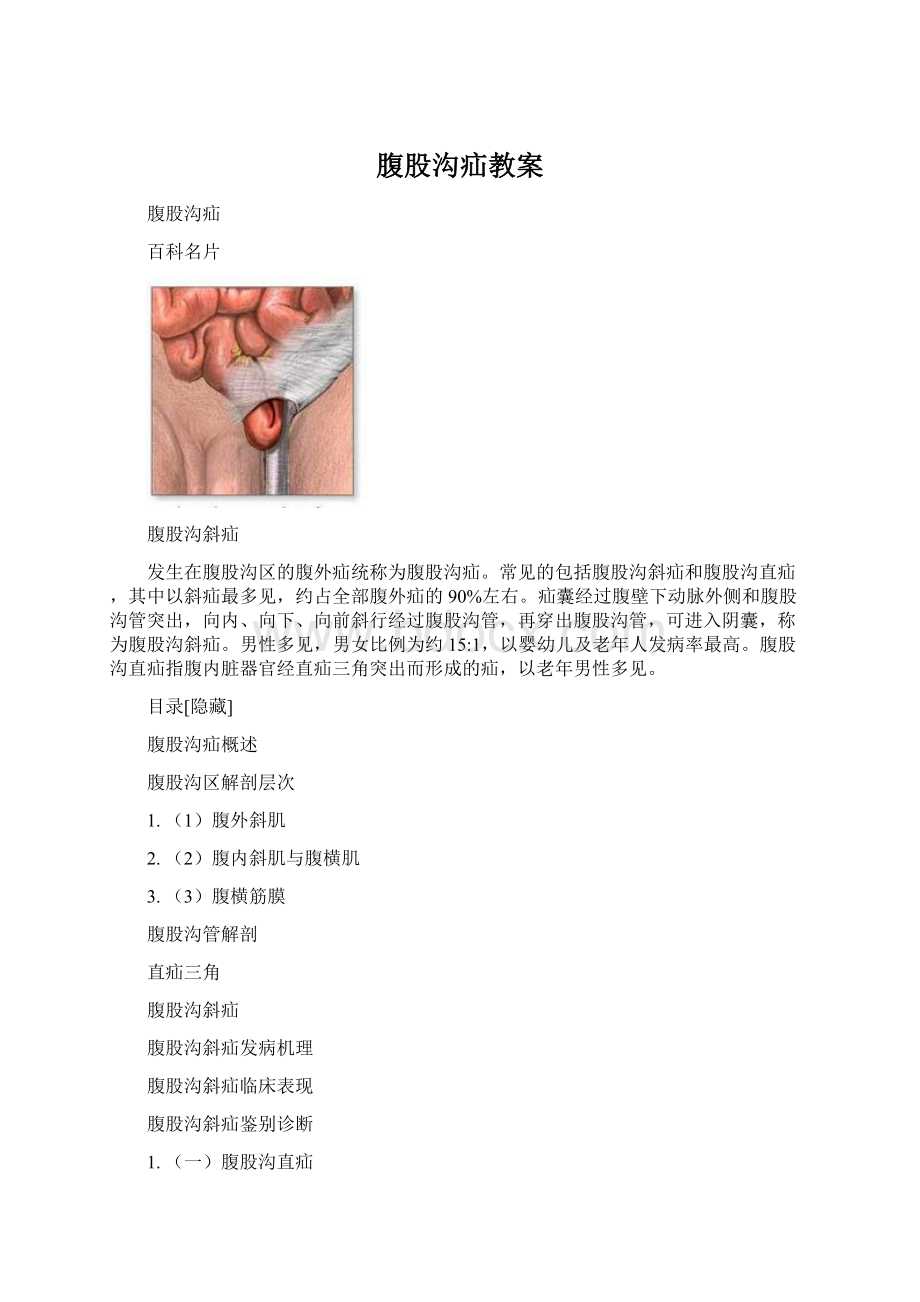 腹股沟疝教案Word下载.docx