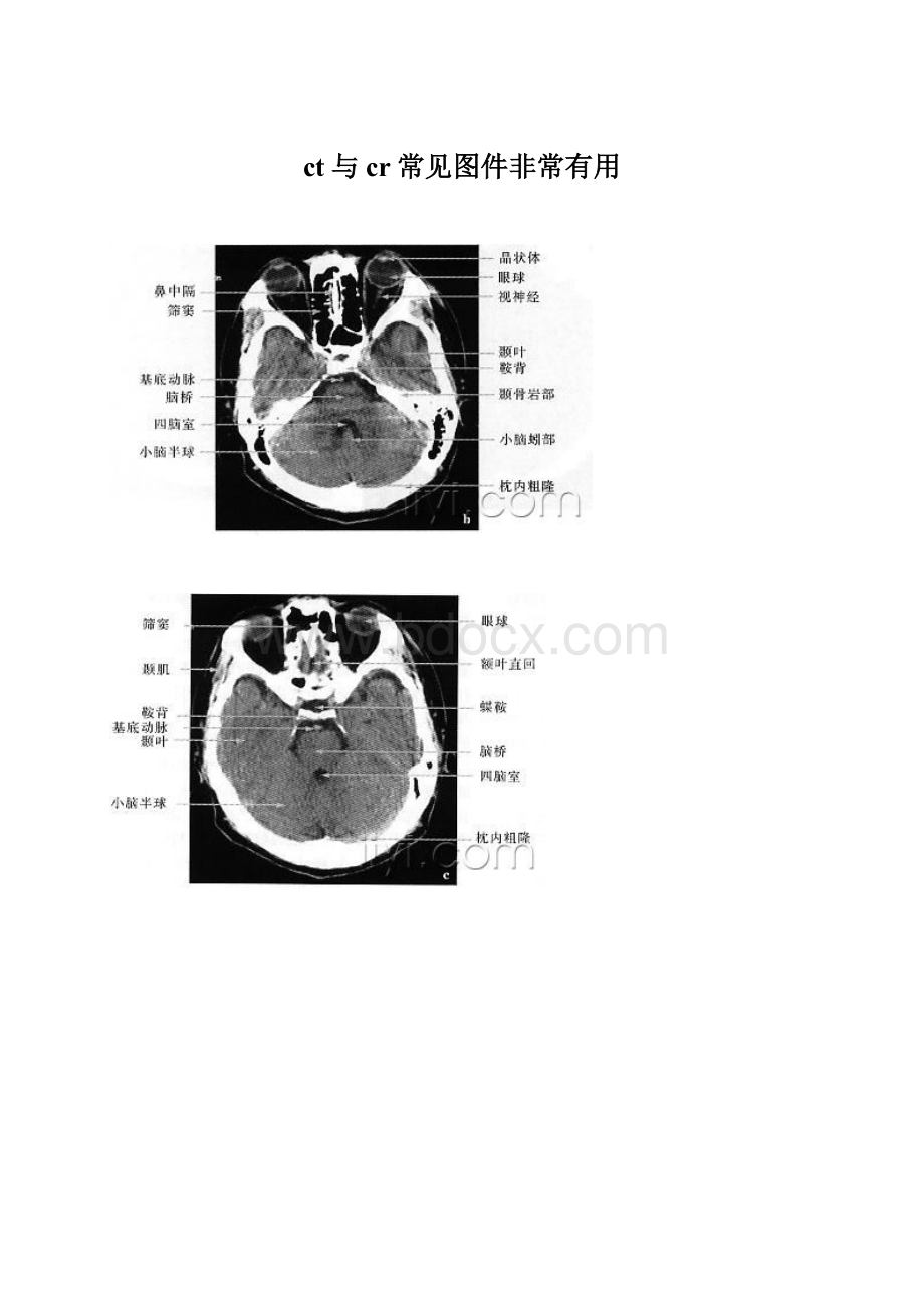 ct与cr常见图件非常有用.docx_第1页