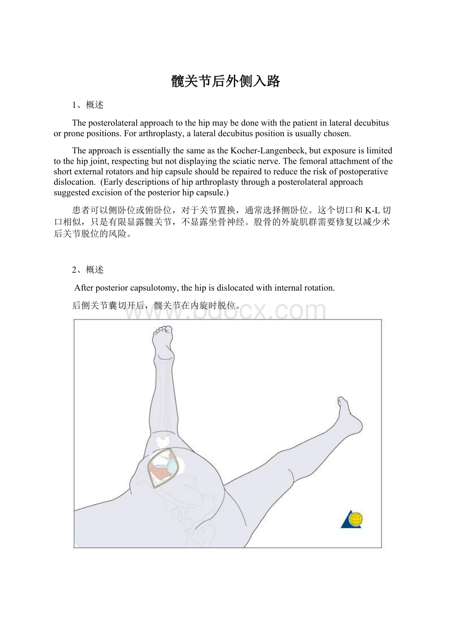 髋关节后外侧入路.docx