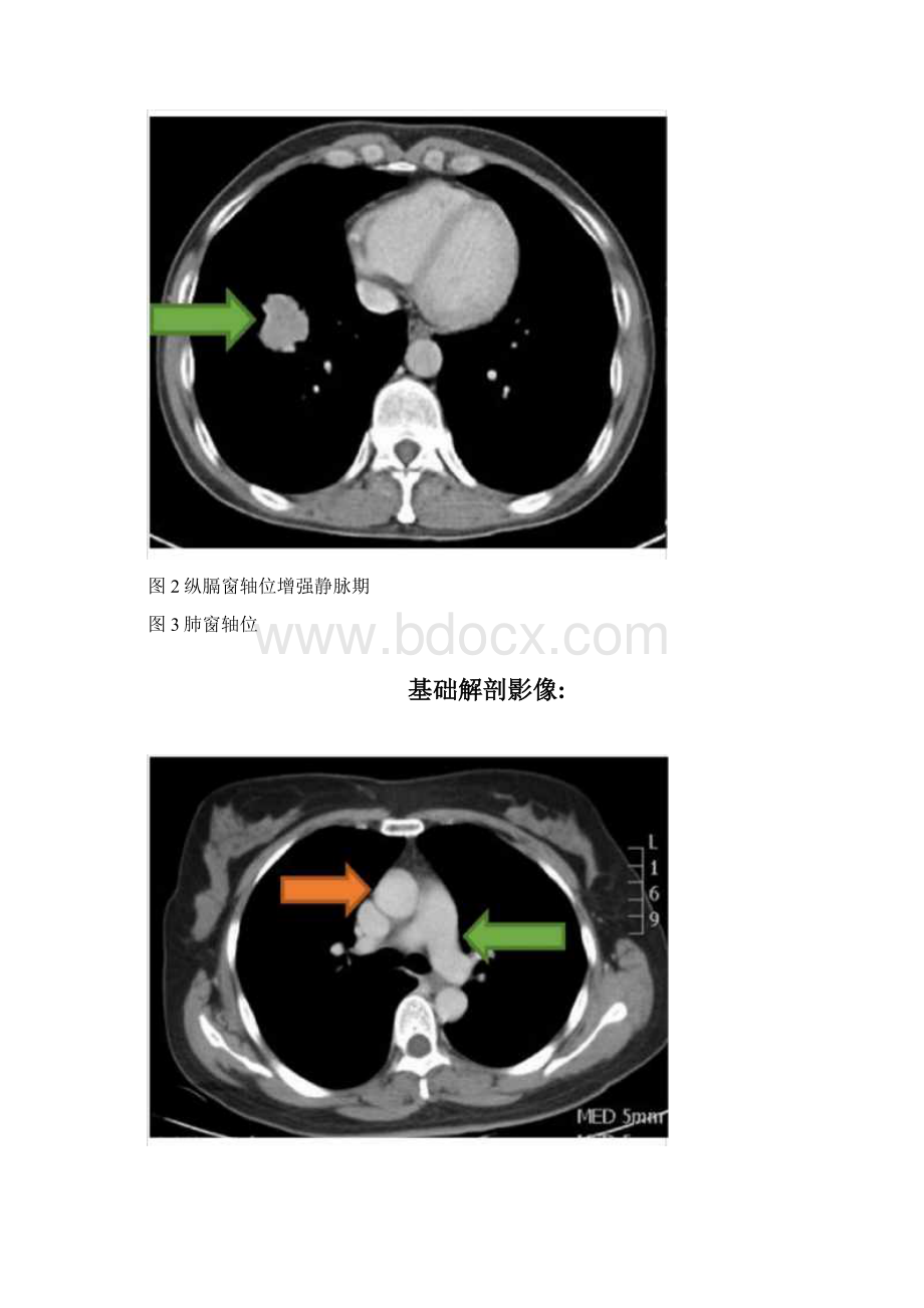 周围型肺癌CT诊断及鉴别诊断.docx_第2页