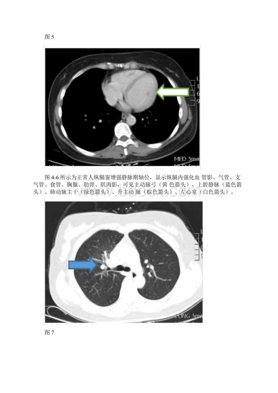 周围型肺癌CT诊断及鉴别诊断.docx_第3页