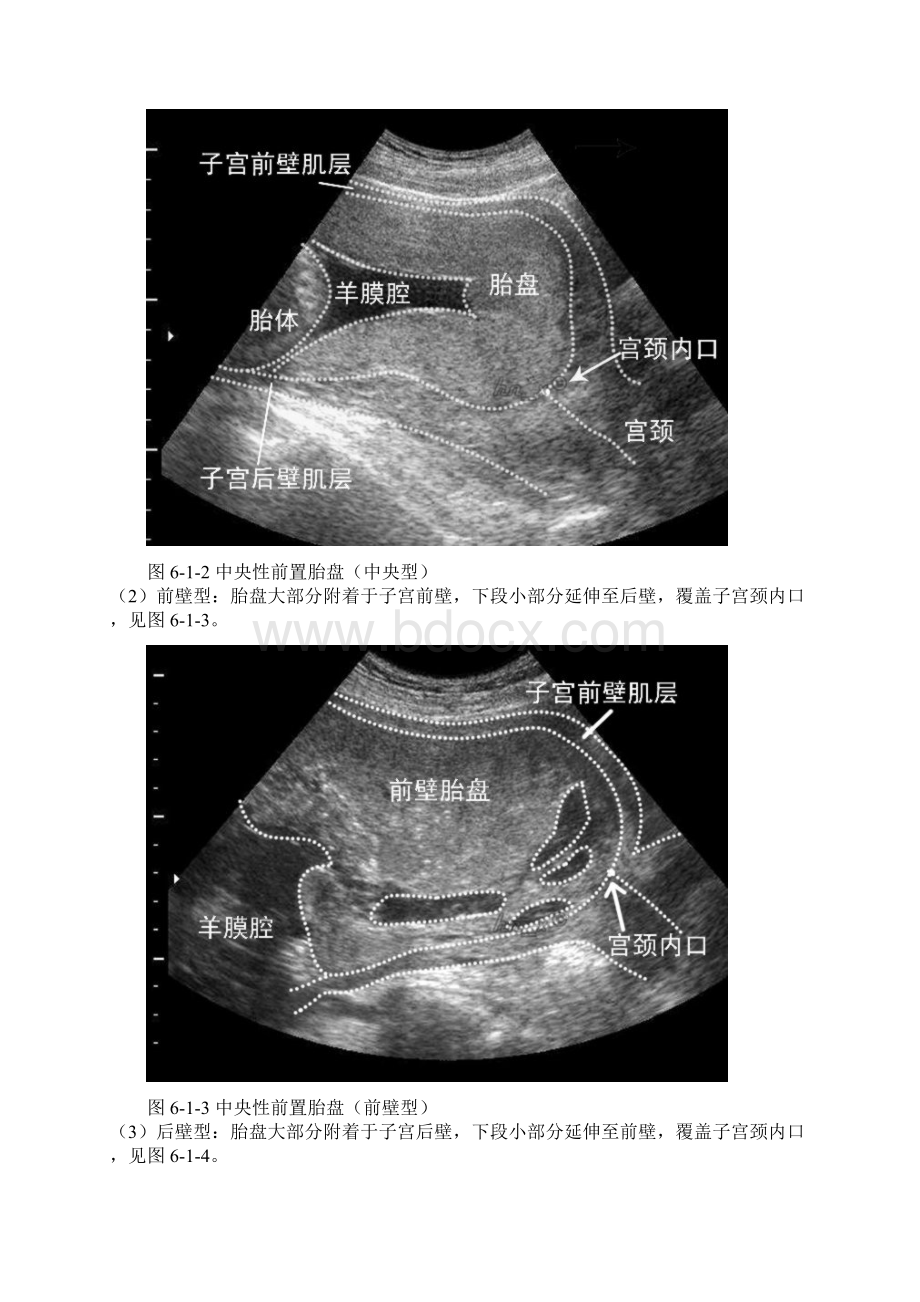 第六章 胎儿附属结构异常的超声诊断Word文档下载推荐.docx_第2页