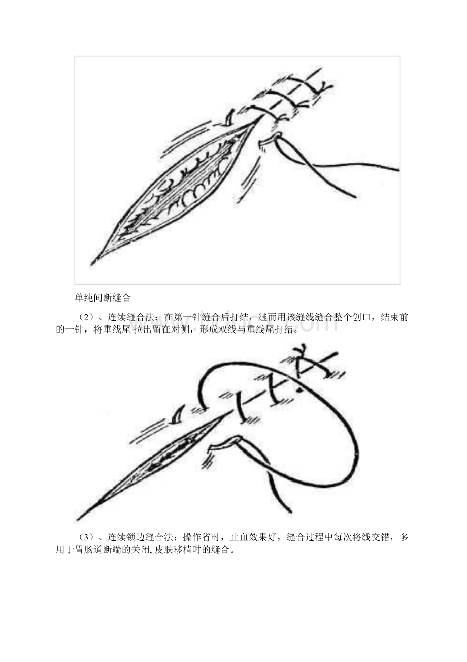 外科缝合与打结图解版.docx_第3页