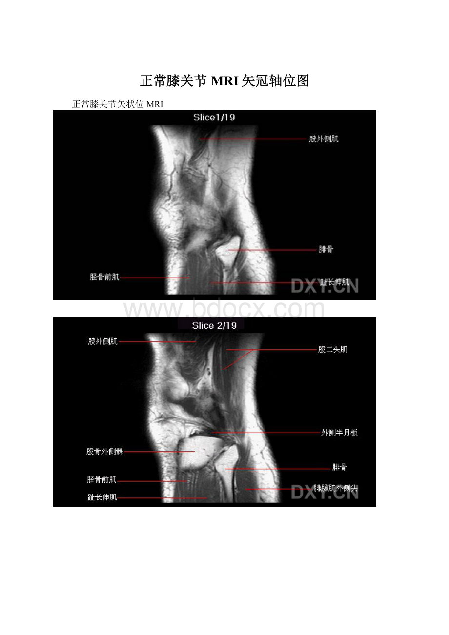 正常膝关节MRI矢冠轴位图.docx_第1页