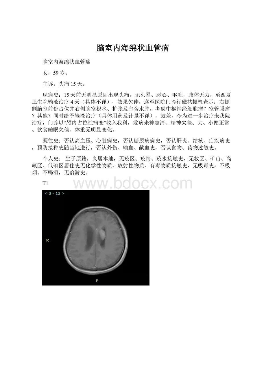 脑室内海绵状血管瘤.docx_第1页