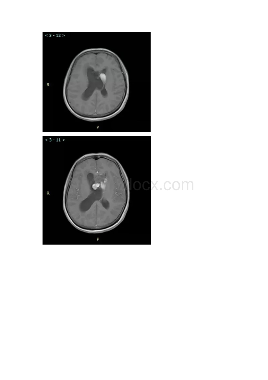 脑室内海绵状血管瘤.docx_第2页