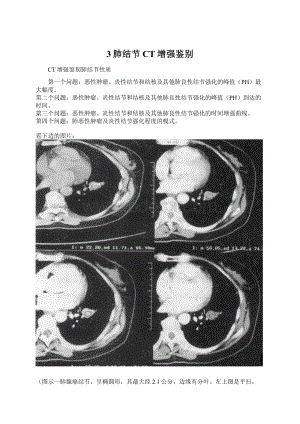 3肺结节CT增强鉴别文档格式.docx