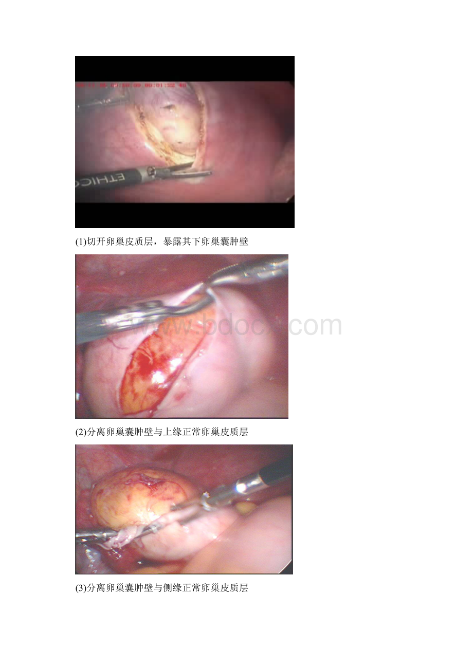 整理腹腔镜下卵巢囊肿剥除术Word文档下载推荐.docx_第2页